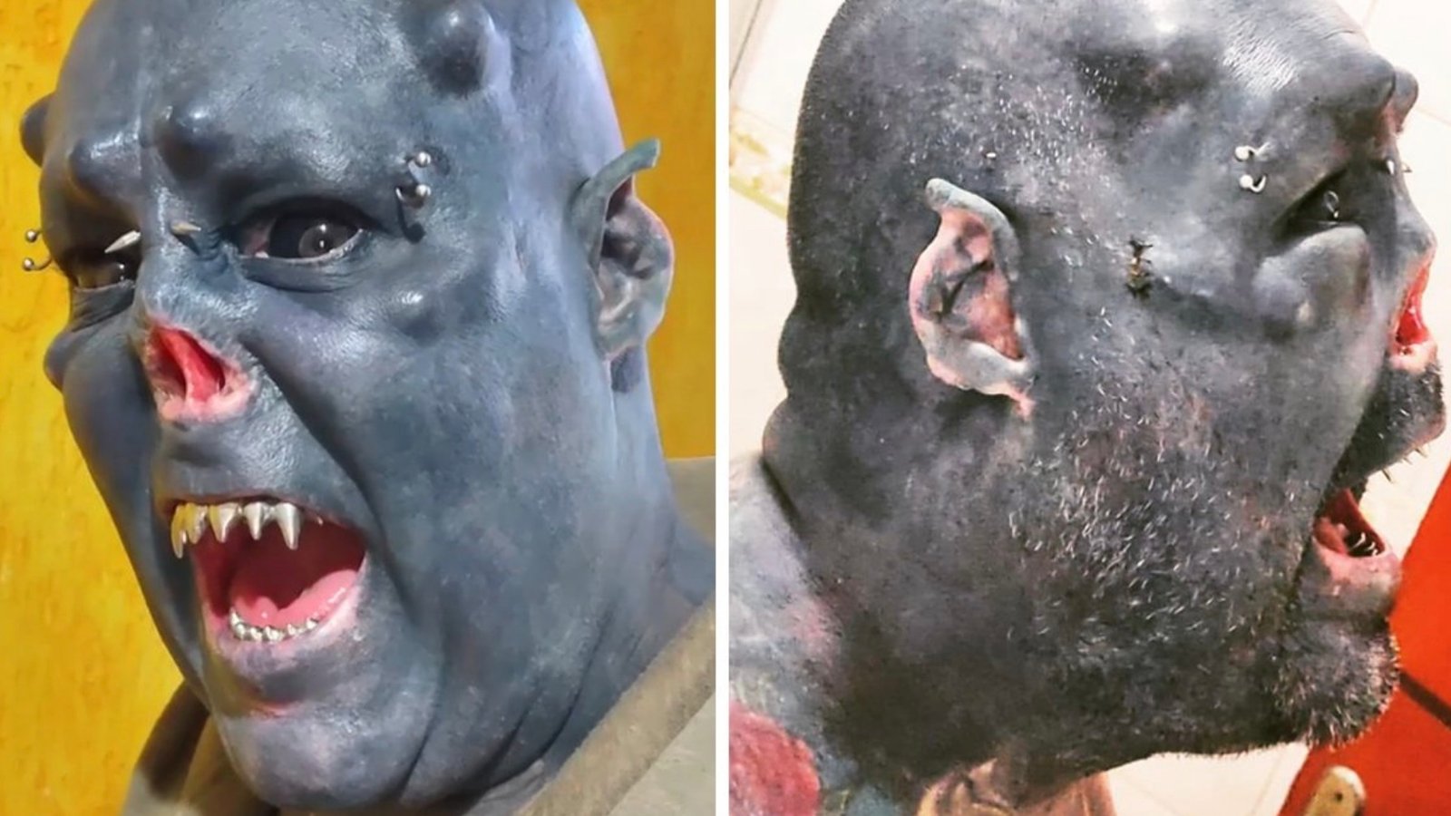 Un homme qui s'est fait enlever le nez et une partie des oreilles montre à quoi il ressemblait avant toutes ses chirurgies.