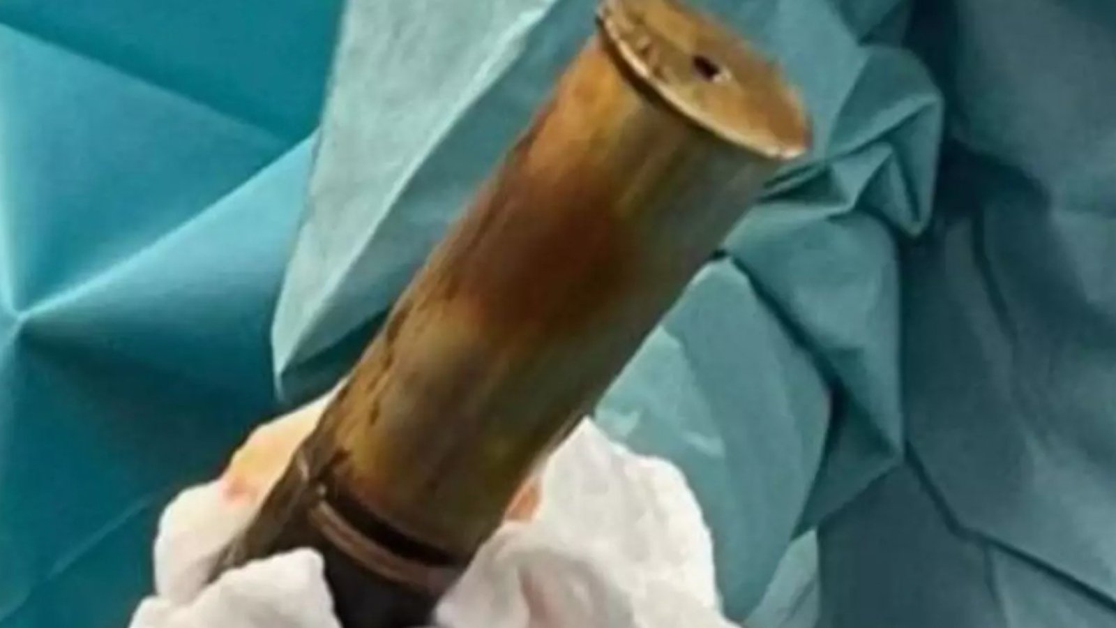 Un homme de 88 ans opéré en raison d'un obus coincé dans le postérieur