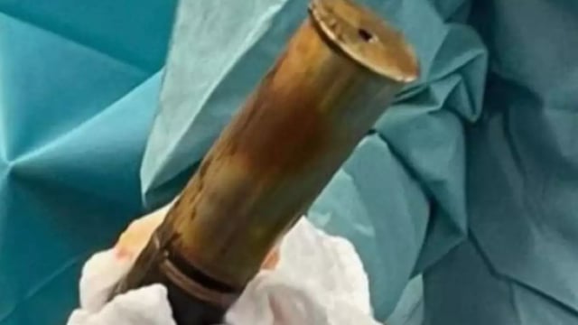Un homme de 88 ans opéré en raison d'un obus coincé dans le postérieur