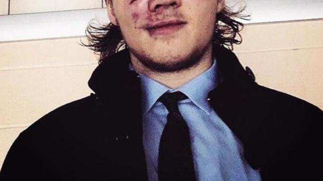 (PHOTOS): Prospect posts picture of his battered face after a rough game.